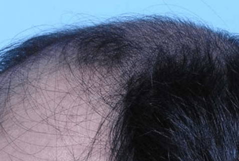 男性脱发, 洗头掉头发多的原因, 这么做可以减少脱发