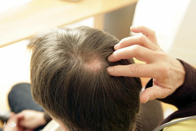 掉头发严重是什么原因? 改善推荐三方法