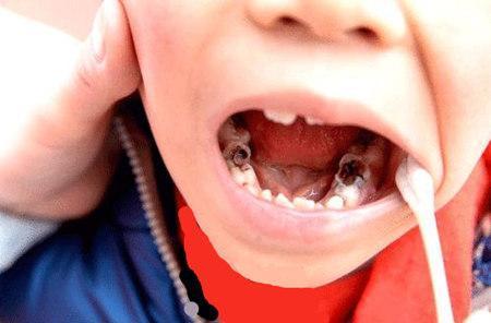 小孩吃糖牙齿坏图片图片