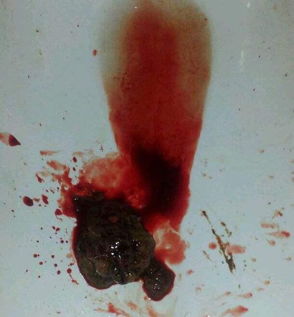 结肠癌粪便图片 潜血图片